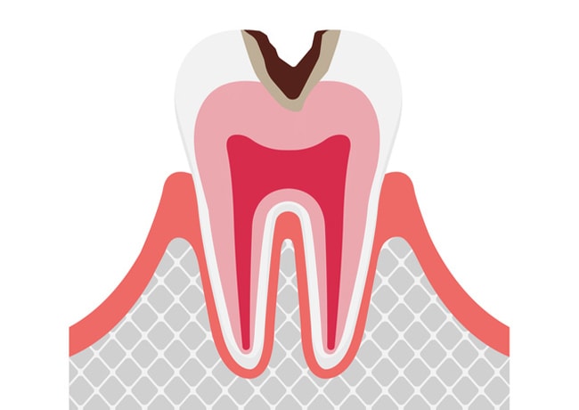 象牙質の虫歯の図