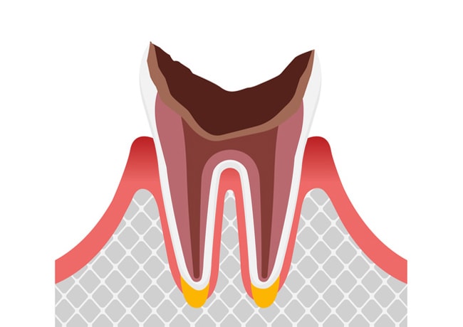 歯の根まで達した虫歯の図