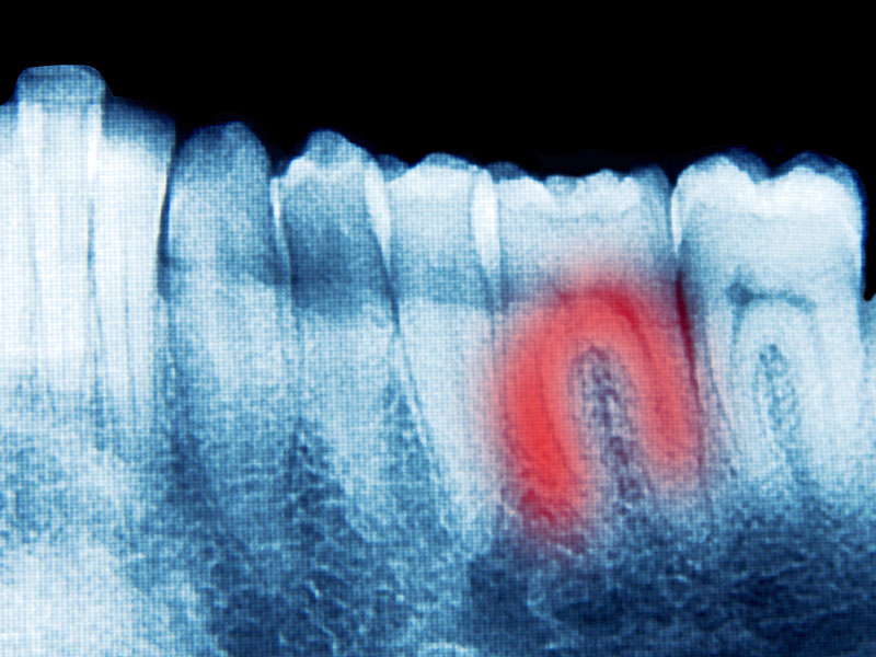 根尖性歯周炎のレントゲン写真