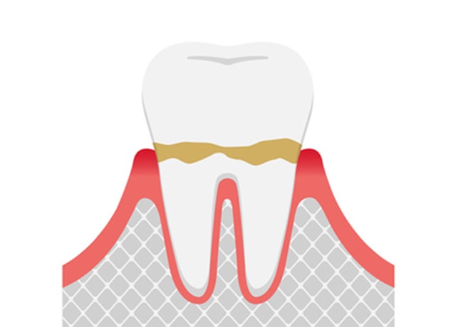 軽度歯周の図