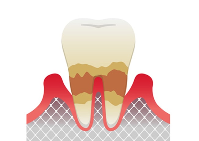 中等度歯周炎の図